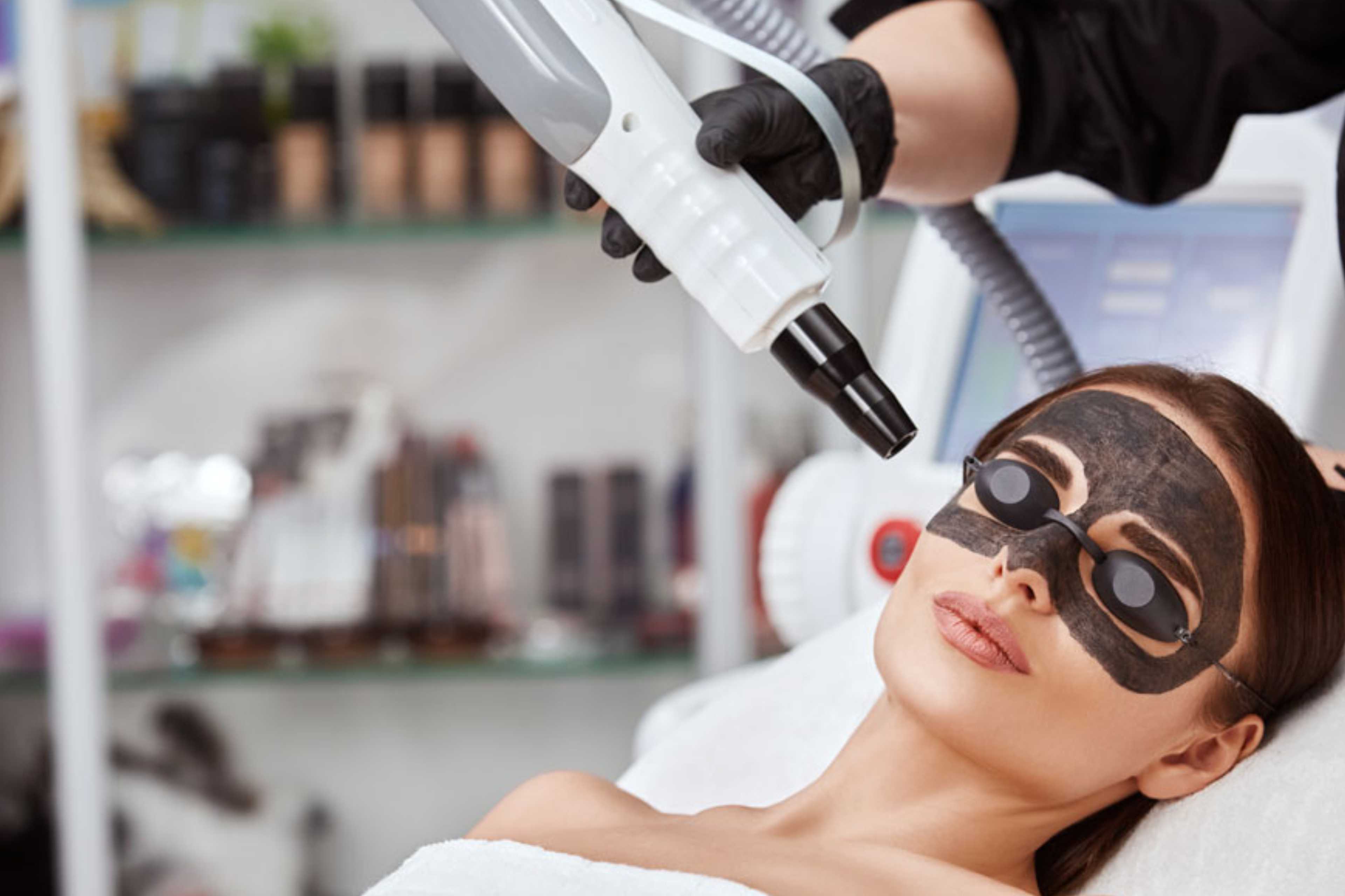 Before and after carbon laser treatment results